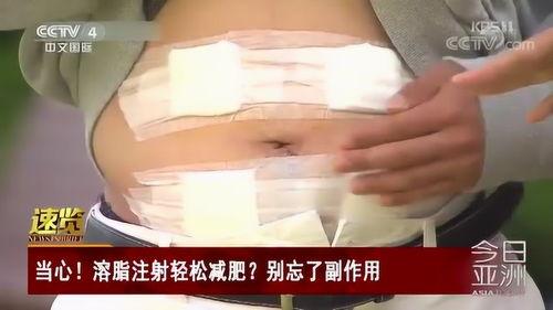 注射溶脂视频,高效塑形美肤新选择